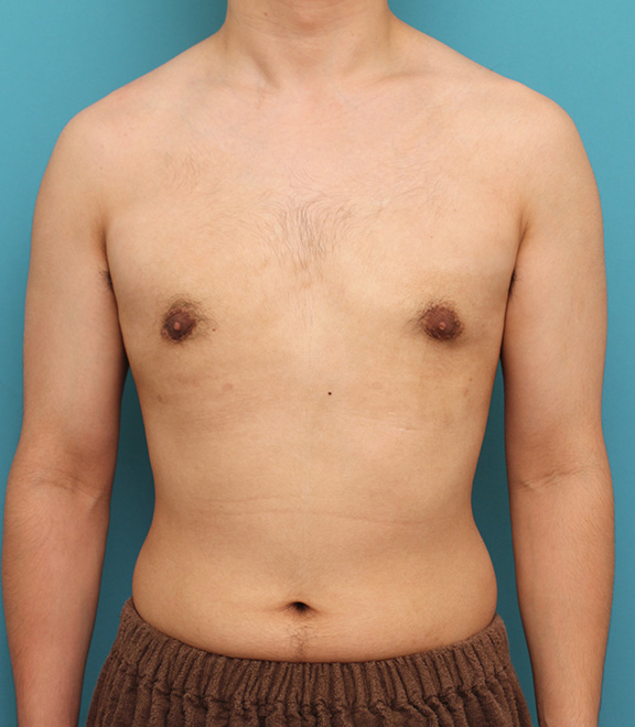 女性化乳房除去,真性女性化乳房の乳腺除去手術の症例写真,After（8ヶ月後）,ba_gynecomastia010_a01.jpg