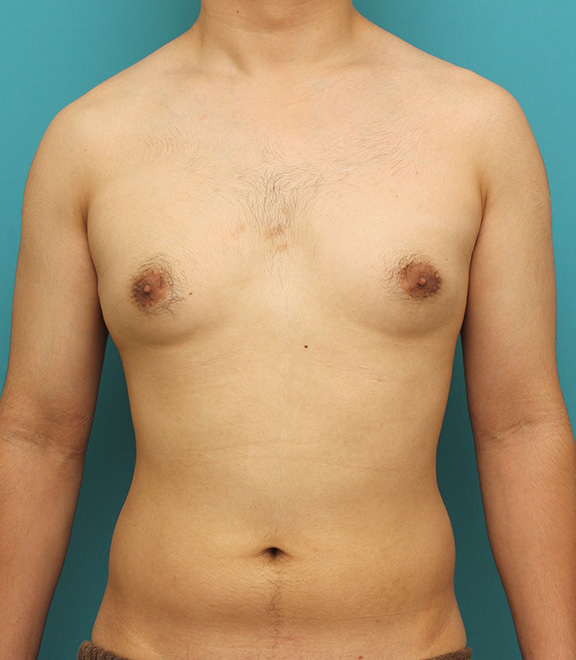症例写真,真性女性化乳房の乳腺除去手術の症例写真,Before,ba_gynecomastia010_b01.jpg