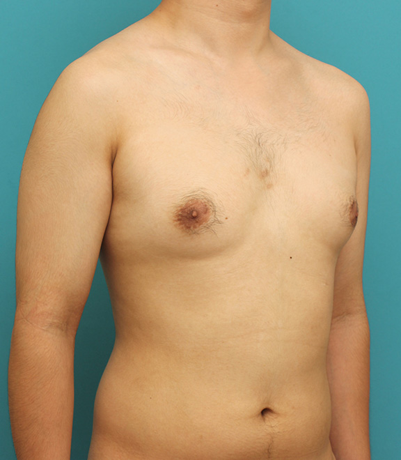 女性化乳房除去,真性女性化乳房の乳腺除去手術の症例写真,Before,ba_gynecomastia010_b02.jpg