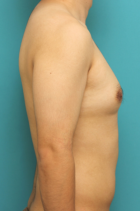 女性化乳房除去,真性女性化乳房の乳腺除去手術の症例写真,Before,ba_gynecomastia010_b03.jpg
