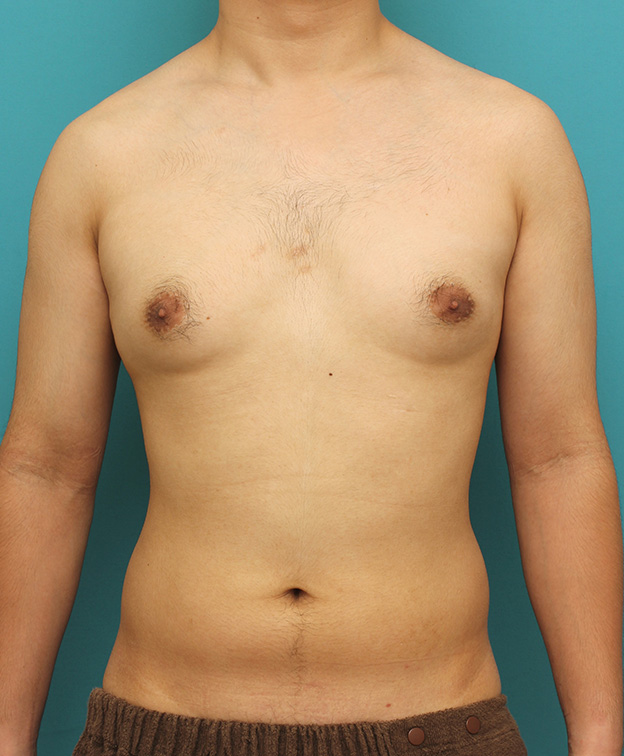 症例写真,真性女性化乳房の乳腺除去手術の症例写真,手術前,mainpic_gynecomastia010a.jpg