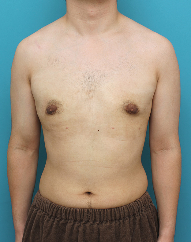 女性化乳房除去,真性女性化乳房の乳腺除去手術の症例写真,3ヶ月後,mainpic_gynecomastia010f.jpg