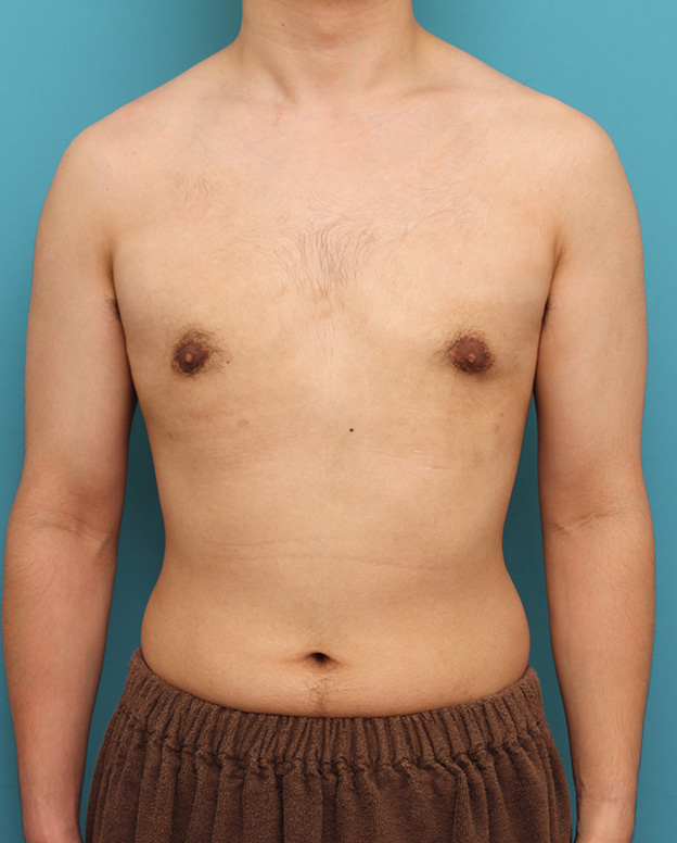 女性化乳房除去,真性女性化乳房の乳腺除去手術の症例写真,8ヶ月後,mainpic_gynecomastia010g.jpg