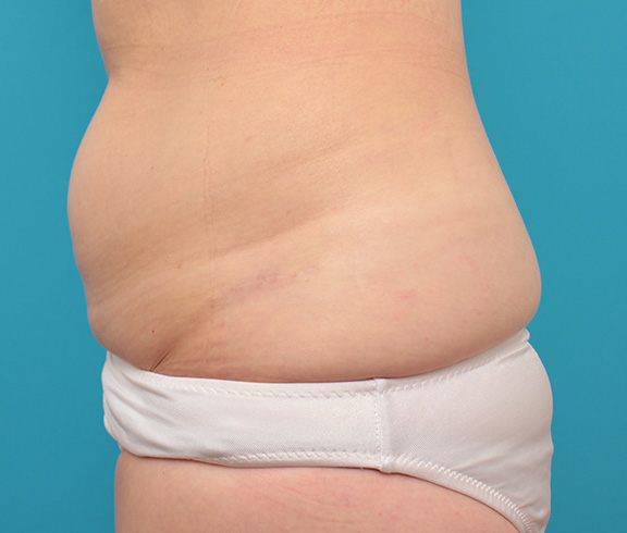 刺青（タトゥー）除去,若い女性の腰の入れ墨を切除縫縮手術で除去した症例写真,After（手術後1年）,ba_irezumi033_b01.jpg