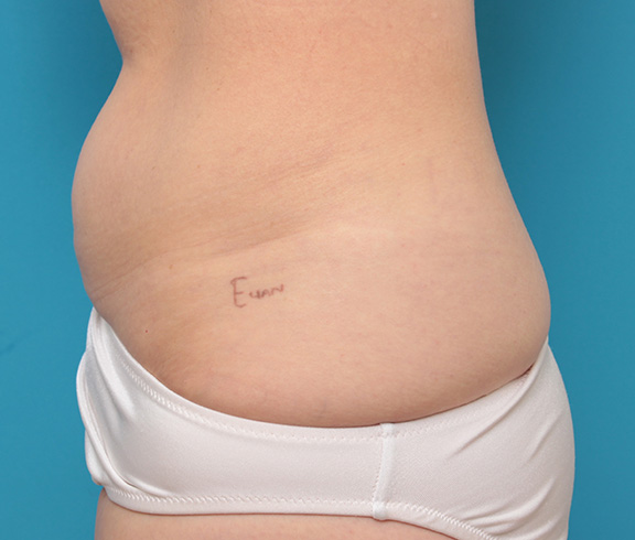 刺青（タトゥー）除去,若い女性の腰の入れ墨を切除縫縮手術で除去した症例写真,Before,ba_irezumi033_b01.jpg