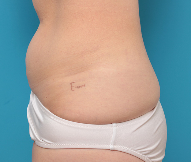 症例写真,若い女性の腰の入れ墨を切除縫縮手術で除去した症例写真,手術前,mainpic_irezumi033a.jpg