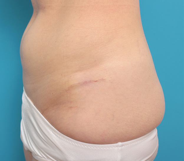 刺青（タトゥー）除去,若い女性の腰の入れ墨を切除縫縮手術で除去した症例写真,3ヶ月後,mainpic_irezumi033e.jpg
