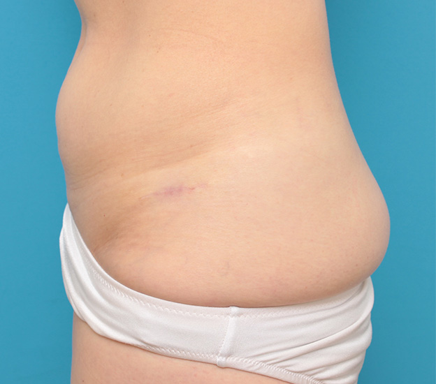 刺青（タトゥー）除去,若い女性の腰の入れ墨を切除縫縮手術で除去した症例写真,6ヶ月後,mainpic_irezumi033f.jpg