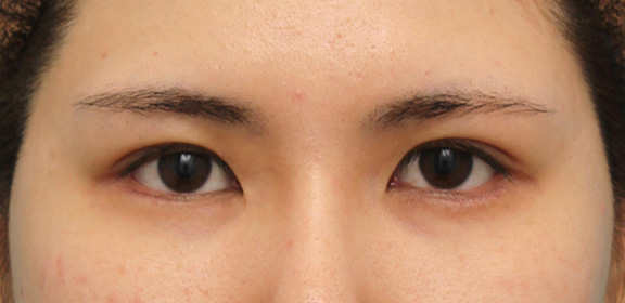 垂れ目（パンダ目）形成（グラマラスライン／下眼瞼下制術）,二重まぶた埋没法2針固定+タレ目形成（グラマラスライン）の症例写真,After（6ヶ月後）,ba_maibotsu039_b01.jpg