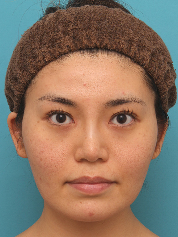 イタリアンリフトで頬のたるみをリフトアップした30代女性の症例写真,Before,ba_italian020_b01.jpg