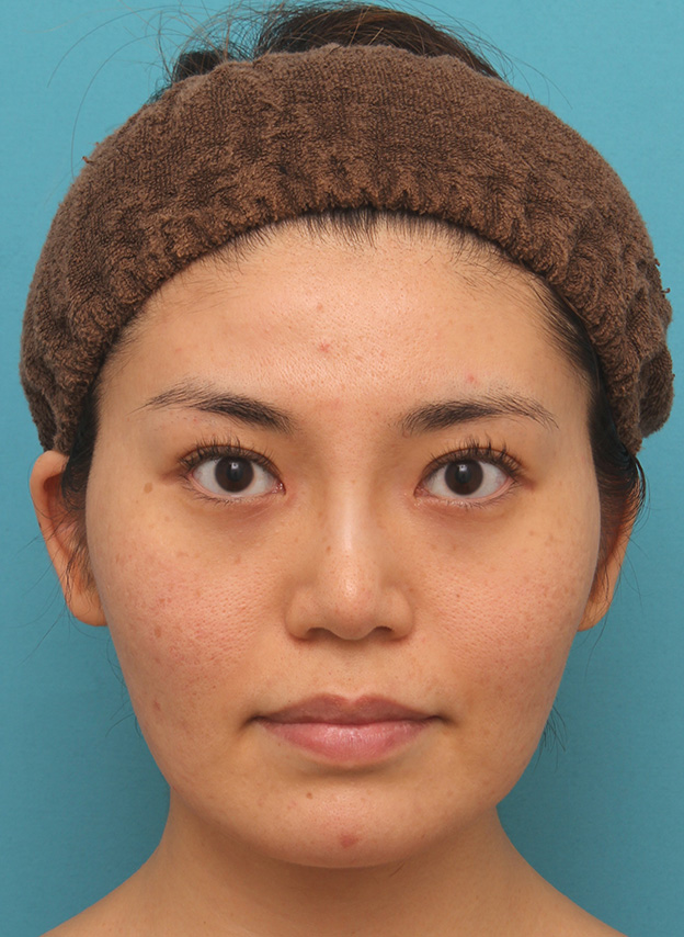 イタリアンリフト,イタリアンリフトで頬のたるみをリフトアップした30代女性の症例写真,手術前,mainpic_italian020a.jpg