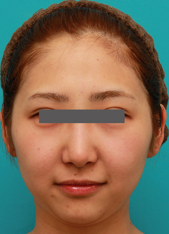 二重あご改善,小顔専用脂肪溶解注射メソシェイプフェイスで小顔になった症例写真,Before,ba_meso_face006_b01.jpg