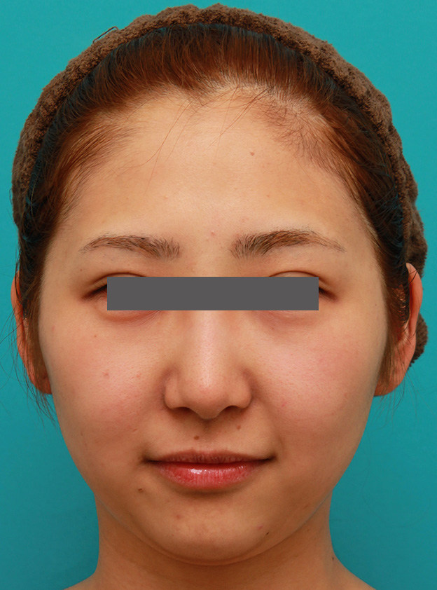 二重あご改善,小顔専用脂肪溶解注射メソシェイプフェイスで小顔になった症例写真,注射前,mainpic_meso_face006a.jpg