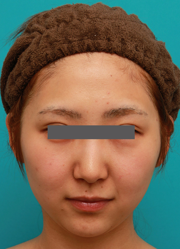 二重あご改善,小顔専用脂肪溶解注射メソシェイプフェイスで小顔になった症例写真,1回目注射後3週間,mainpic_meso_face006c.jpg