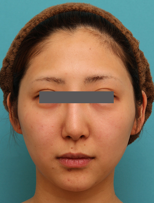 二重あご改善,小顔専用脂肪溶解注射メソシェイプフェイスで小顔になった症例写真,4回目注射後2週間,mainpic_meso_face006f.jpg