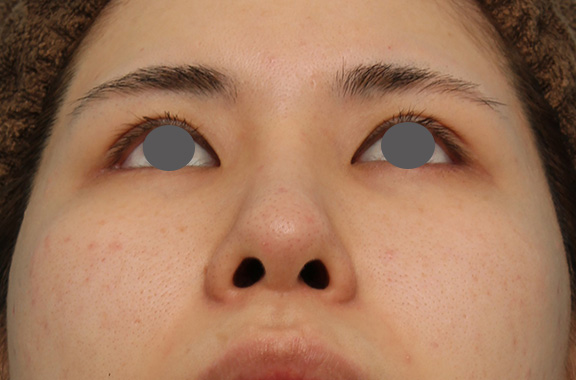 隆鼻術（シリコンプロテーゼ）,鼻のシリコンプロテーゼ+鼻先の耳介軟骨移植の症例写真,After（6ヶ月後）,ba_jikai040_b04.jpg
