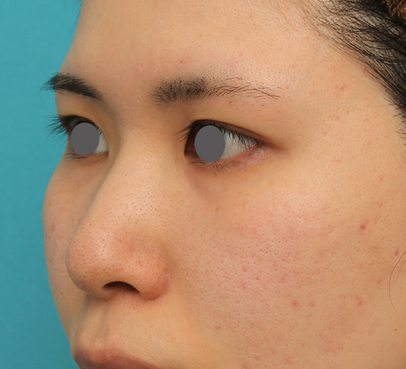 症例写真,鼻のシリコンプロテーゼ+鼻先の耳介軟骨移植の症例写真,Before,ba_jikai040_b02.jpg