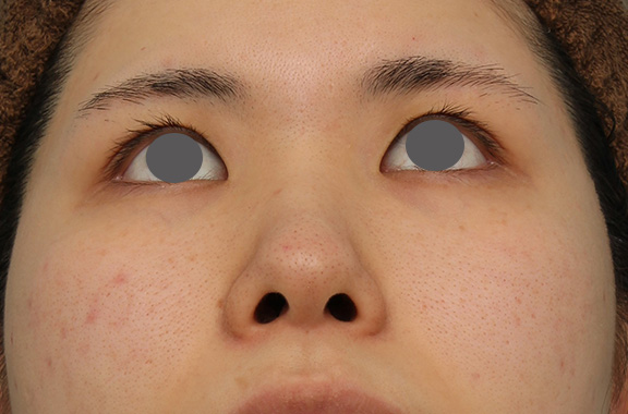 隆鼻術（シリコンプロテーゼ）,鼻のシリコンプロテーゼ+鼻先の耳介軟骨移植の症例写真,Before,ba_jikai040_b04.jpg