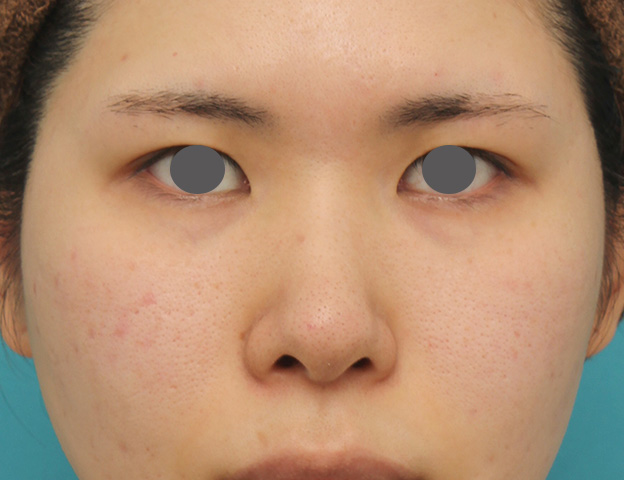 隆鼻術（シリコンプロテーゼ）,鼻のシリコンプロテーゼ+鼻先の耳介軟骨移植の症例写真,手術前,mainpic_jikai040a.jpg
