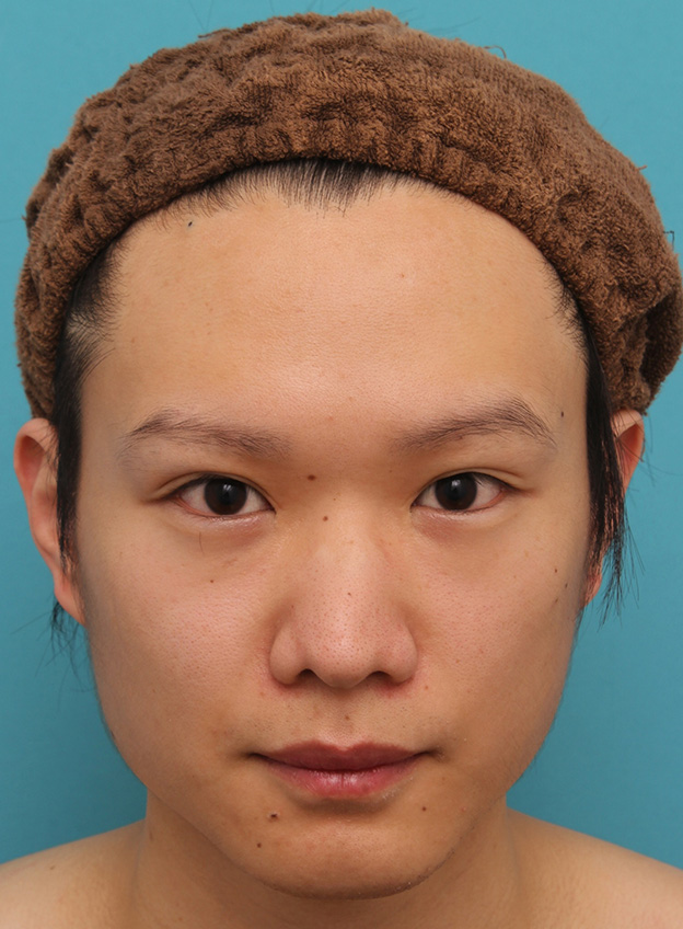 目頭切開,目頭切開でかなり目を内側に大きく広げた男性の症例写真,2年11ヶ月後,mainpic_megashira056d.jpg