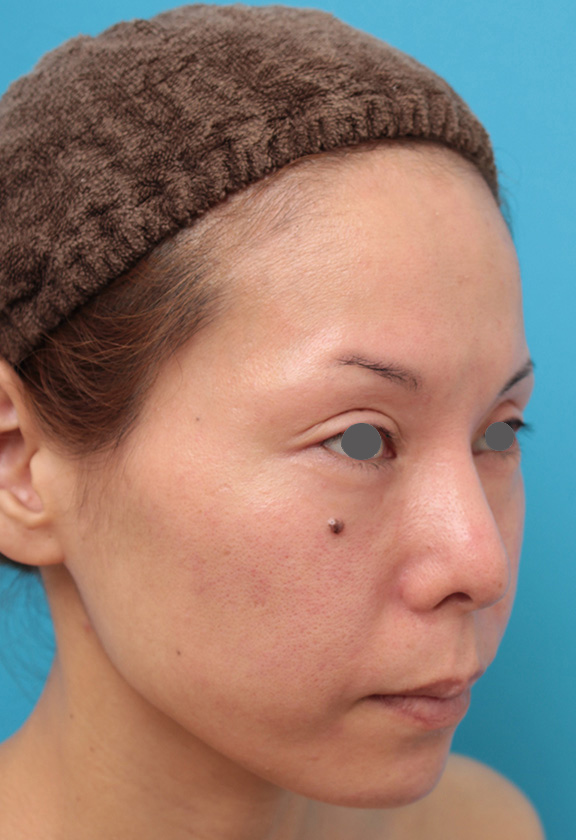 あご注射（ヒアルロン酸）,ヒアルロン酸注射で顎先を前方に出した30代女性の症例写真,After（1ヶ月後）,ba_agochu012_b02.jpg