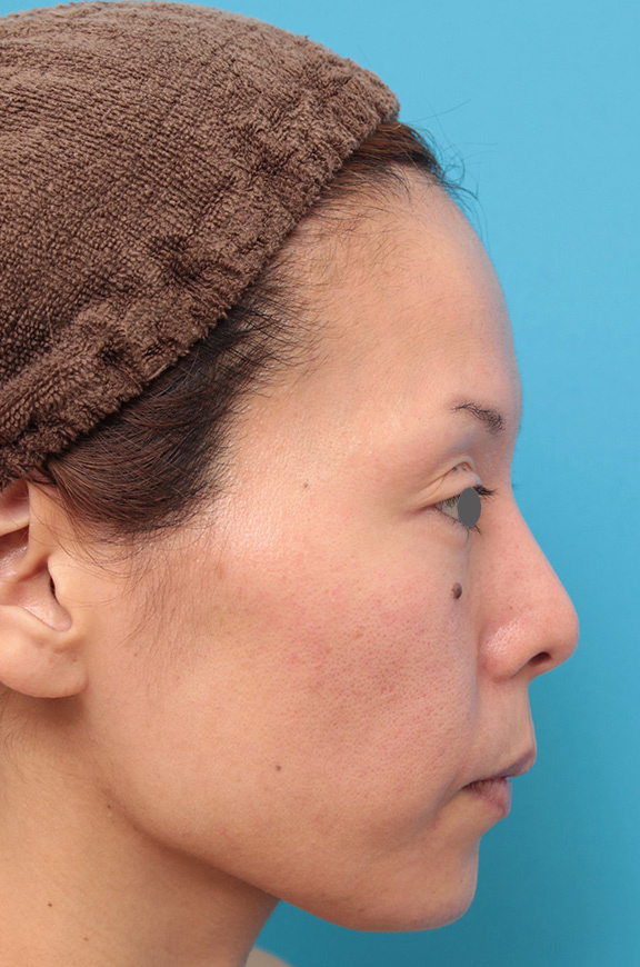 あご注射（ヒアルロン酸）,ヒアルロン酸注射で顎先を前方に出した30代女性の症例写真,After（1ヶ月後）,ba_agochu012_b03.jpg