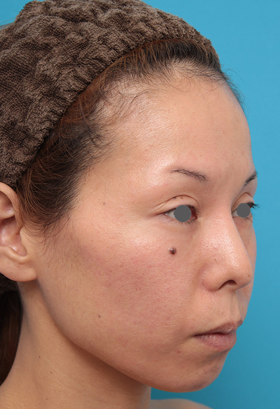 あご注射（ヒアルロン酸）,ヒアルロン酸注射で顎先を前方に出した30代女性の症例写真,Before,ba_agochu012_b02.jpg