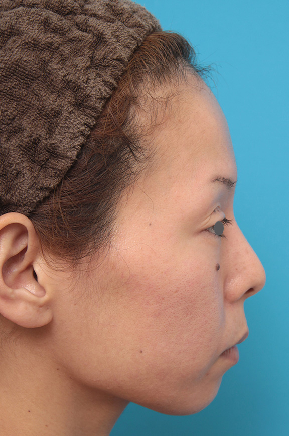 あご注射（ヒアルロン酸）,ヒアルロン酸注射で顎先を前方に出した30代女性の症例写真,Before,ba_agochu012_b03.jpg