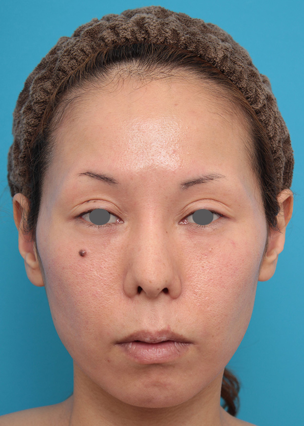 あご注射（ヒアルロン酸）,ヒアルロン酸注射で顎先を前方に出した30代女性の症例写真,治療前,mainpic_agochu012a.jpg