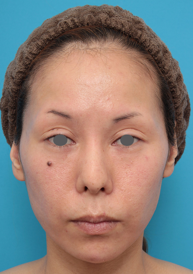 症例写真,ヒアルロン酸注射で顎先を前方に出した30代女性の症例写真,手術直後,mainpic_agochu012b.jpg