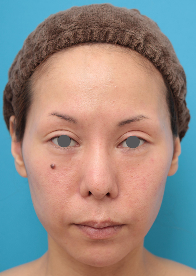 あご注射（ヒアルロン酸）,ヒアルロン酸注射で顎先を前方に出した30代女性の症例写真,1週間後,mainpic_agochu012c.jpg