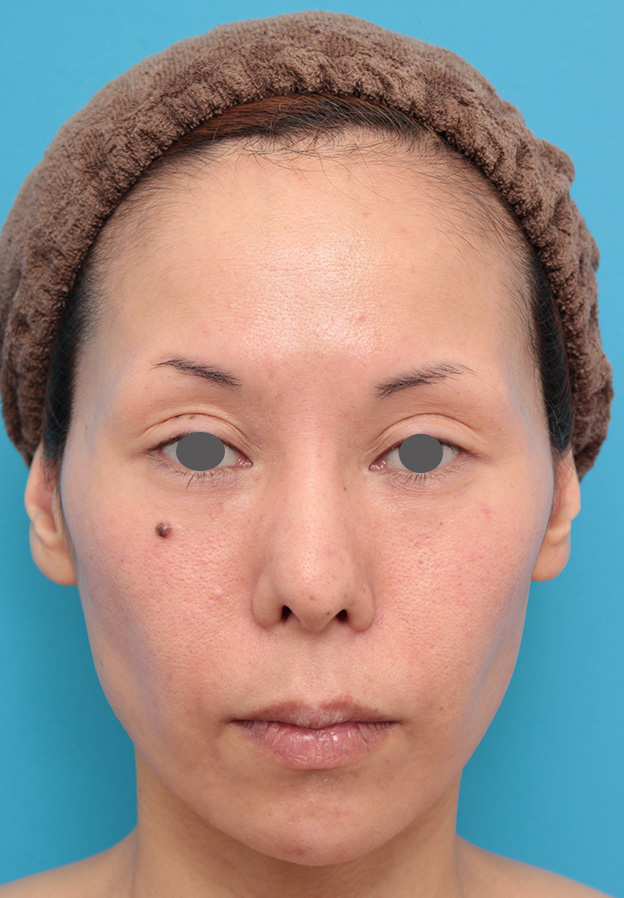 あご注射（ヒアルロン酸）,ヒアルロン酸注射で顎先を前方に出した30代女性の症例写真,1ヶ月後,mainpic_agochu012d.jpg