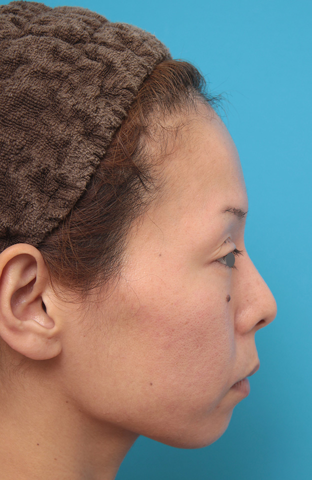 あご注射（ヒアルロン酸）,ヒアルロン酸注射で顎先を前方に出した30代女性の症例写真,治療前,mainpic_agochu012e.jpg