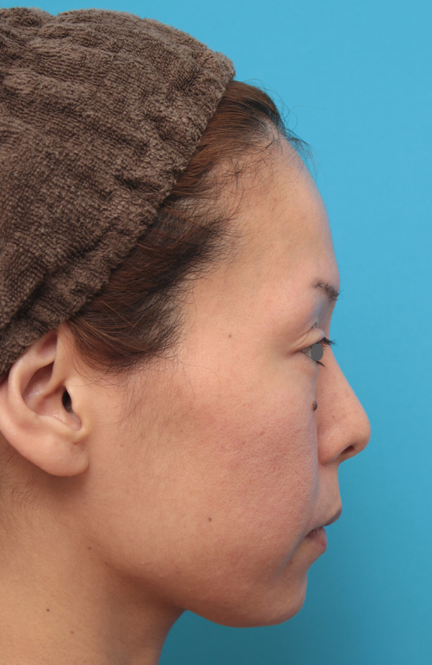 あご注射（ヒアルロン酸）,ヒアルロン酸注射で顎先を前方に出した30代女性の症例写真,手術直後,mainpic_agochu012f.jpg