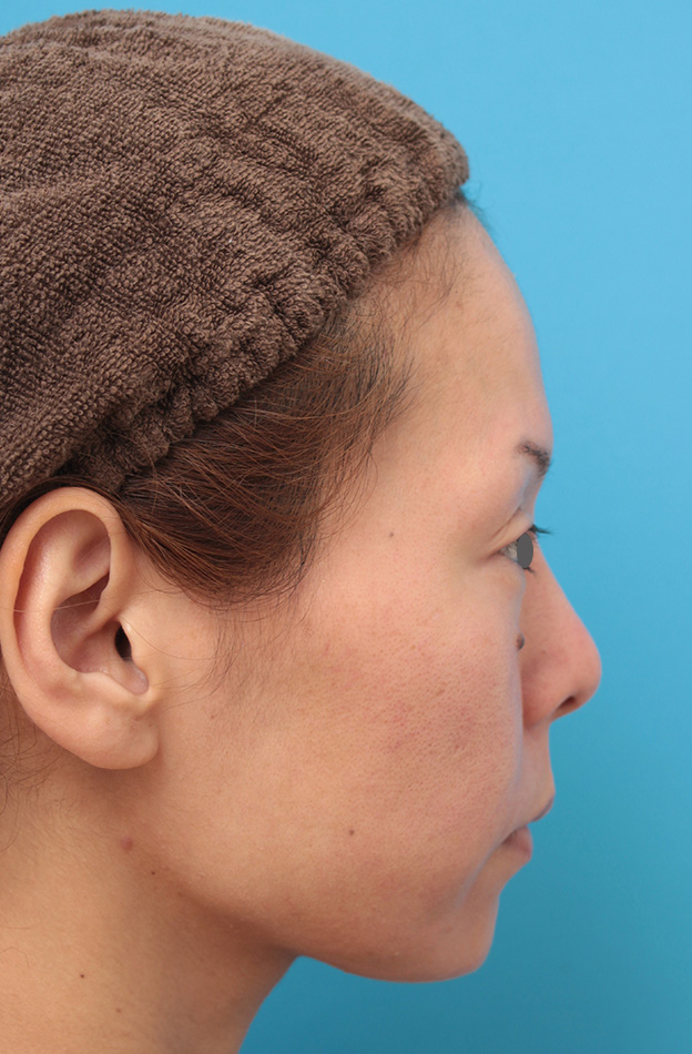 あご注射（ヒアルロン酸）,ヒアルロン酸注射で顎先を前方に出した30代女性の症例写真,1週間後,mainpic_agochu012g.jpg
