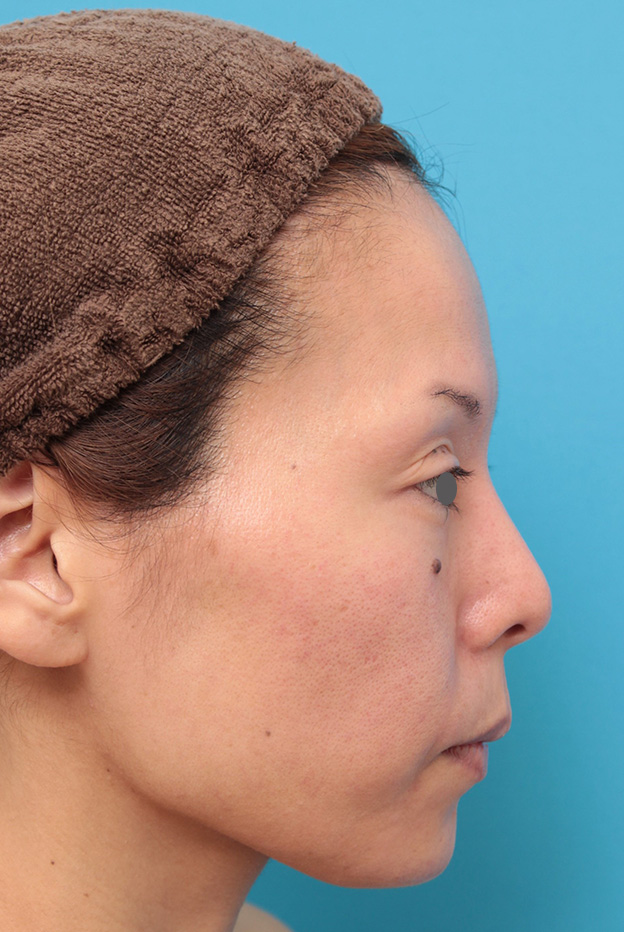 あご注射（ヒアルロン酸）,ヒアルロン酸注射で顎先を前方に出した30代女性の症例写真,1ヶ月後,mainpic_agochu012h.jpg