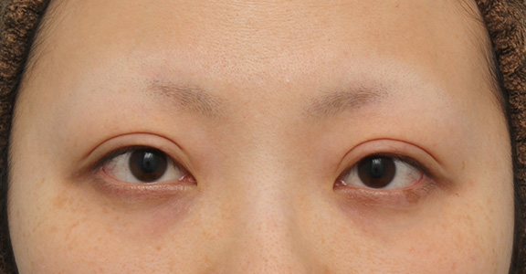眼瞼下垂（がんけんかすい）,眼瞼下垂（がんけんかすい） 眼瞼下垂手術で幅広平行型二重を作った症例写真,After（6ヶ月後）,ba_ganken037_b01.jpg