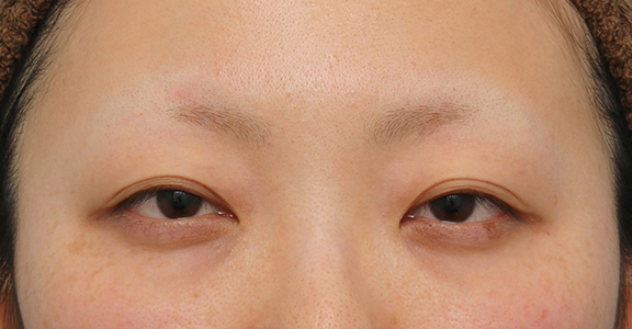 眼瞼下垂（がんけんかすい）,眼瞼下垂（がんけんかすい） 眼瞼下垂手術で幅広平行型二重を作った症例写真,Before,ba_ganken037_b01.jpg