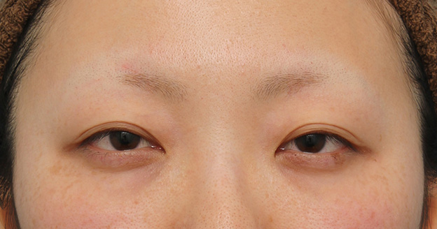 眼瞼下垂（がんけんかすい）,眼瞼下垂（がんけんかすい） 眼瞼下垂手術で幅広平行型二重を作った症例写真,手術前,mainpic_ganken037a.jpg