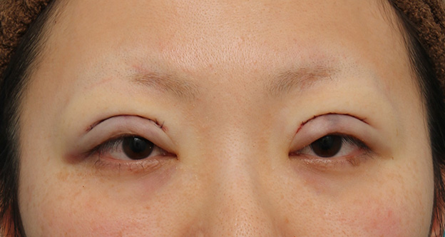 眼瞼下垂（がんけんかすい）,眼瞼下垂（がんけんかすい） 眼瞼下垂手術で幅広平行型二重を作った症例写真,手術直後,mainpic_ganken037b.jpg