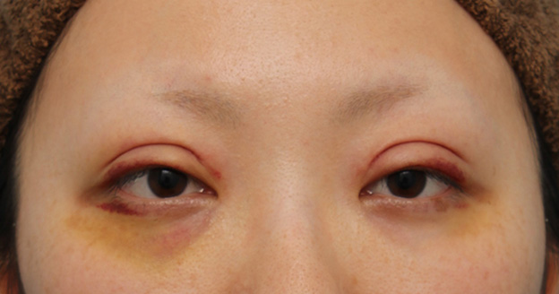 眼瞼下垂（がんけんかすい）,眼瞼下垂（がんけんかすい） 眼瞼下垂手術で幅広平行型二重を作った症例写真,6日後,mainpic_ganken037c.jpg