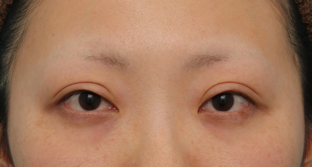 眼瞼下垂（がんけんかすい）,眼瞼下垂（がんけんかすい） 眼瞼下垂手術で幅広平行型二重を作った症例写真,3週間後,mainpic_ganken037d.jpg