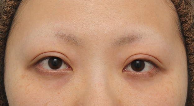 眼瞼下垂（がんけんかすい）,眼瞼下垂（がんけんかすい） 眼瞼下垂手術で幅広平行型二重を作った症例写真,6ヶ月後,mainpic_ganken037e.jpg