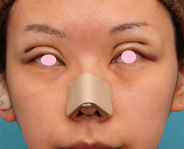 鼻中隔延長（鼻先を大きく下方に延ばす）,鼻中隔延長手術で鼻先を斜め下方向に出した症例写真,手術直後,mainpic_bichukaku003b.jpg