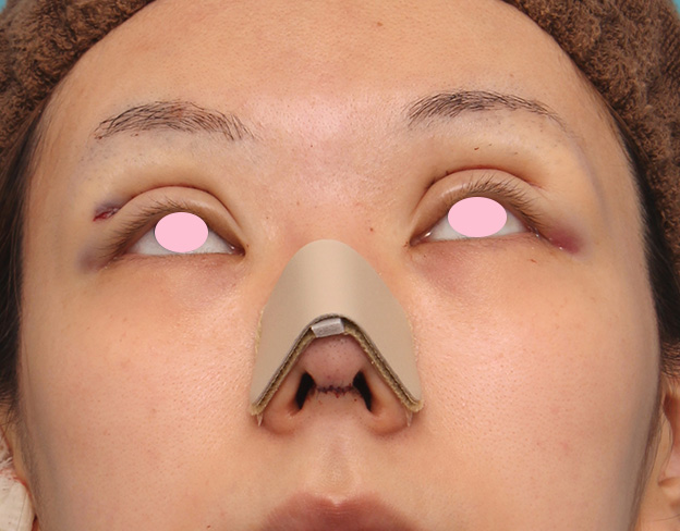 鼻中隔延長（鼻先を大きく下方に延ばす）,鼻中隔延長手術で鼻先を斜め下方向に出した症例写真,手術直後,mainpic_bichukaku003f.jpg