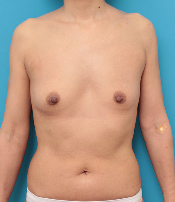 豊胸手術（シリコンプロテーゼ）,左右の大きさが違うバストにシリコンバッグプロテーゼ豊胸手術を行った症例写真,Before,ba_hokyo027_b01.jpg