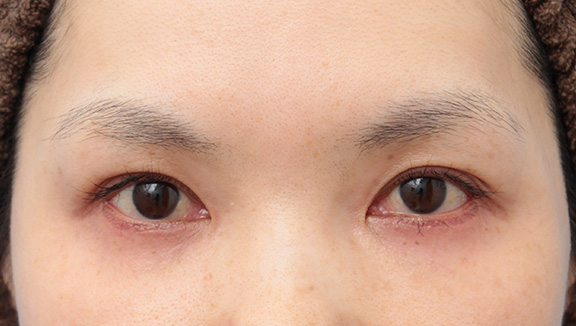 目尻切開,目尻切開とタレ目形成（グラマラスライン）を同時に行った40代女性の症例写真,After（6ヶ月後）,ba_mejiri018_b01.jpg
