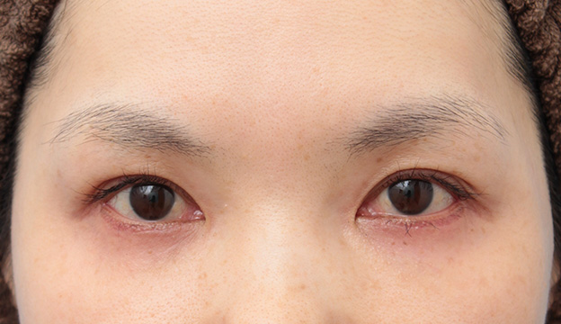 垂れ目（パンダ目）形成（グラマラスライン／下眼瞼下制術）,目尻切開とタレ目形成（グラマラスライン）を同時に行った40代女性の症例写真,6ヶ月後,mainpic_mejiri018e.jpg
