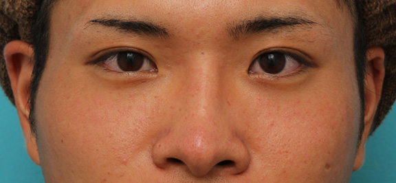 隆鼻注射（ヒアルロン酸注射）,長期持続型ヒアルロン酸により鼻を高くした症例写真,After（1ヶ月後）,ba_ryubi2031_a01.jpg