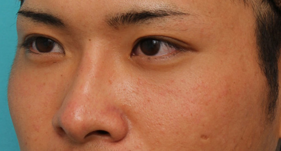 隆鼻注射（ヒアルロン酸注射）,長期持続型ヒアルロン酸により鼻を高くした症例写真,After（1ヶ月後）,ba_ryubi2031_b02.jpg